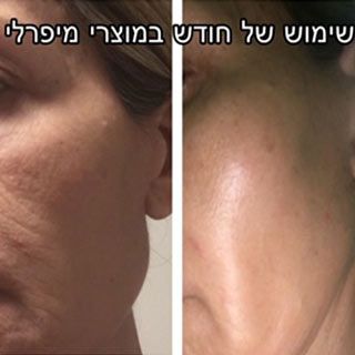 תמונות ותגובות לסרום חומצה ההיאלרונית